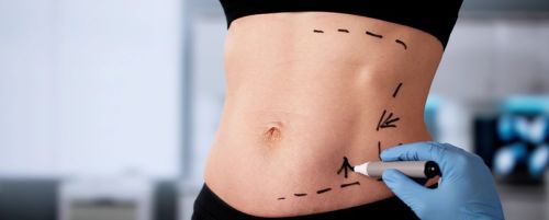 Abdominoplastia (cirugía del abdomen)