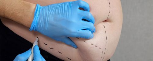 Cirug&iacute;a endosc&oacute;pica obesidad prem&oacute;rbida (M&eacute;todo Apollo)