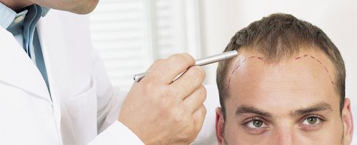 Microinjerto capilar FUSS (entradas)