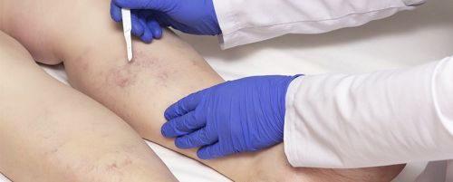 Esclerosis de varices con espuma 1 sesión