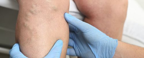 Esclerosis de varices con espuma 5 sesiones