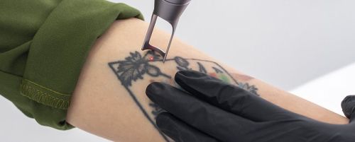 Eliminaci&oacute;n de tatuajes por sesi&oacute;n