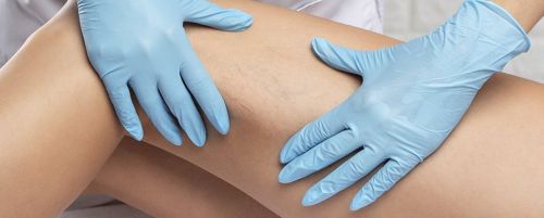 Esclerosis de varices con espuma 3 sesiones