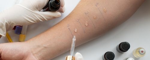 Prueba de alergia