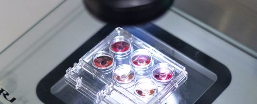 Inseminación artificial con semen de donante (IAD)