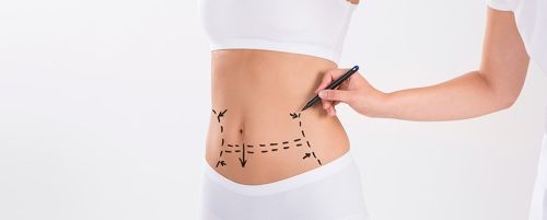 Liposucci&oacute;n (1 sesi&oacute;n)