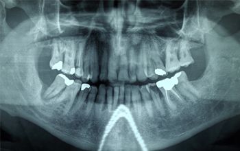 Ortopantomografía o panorámica dental