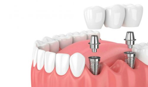 Implantes dentales Las rozas: tipos de coronas dentales