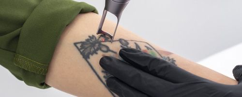 Eliminación de tatuajes por sesión